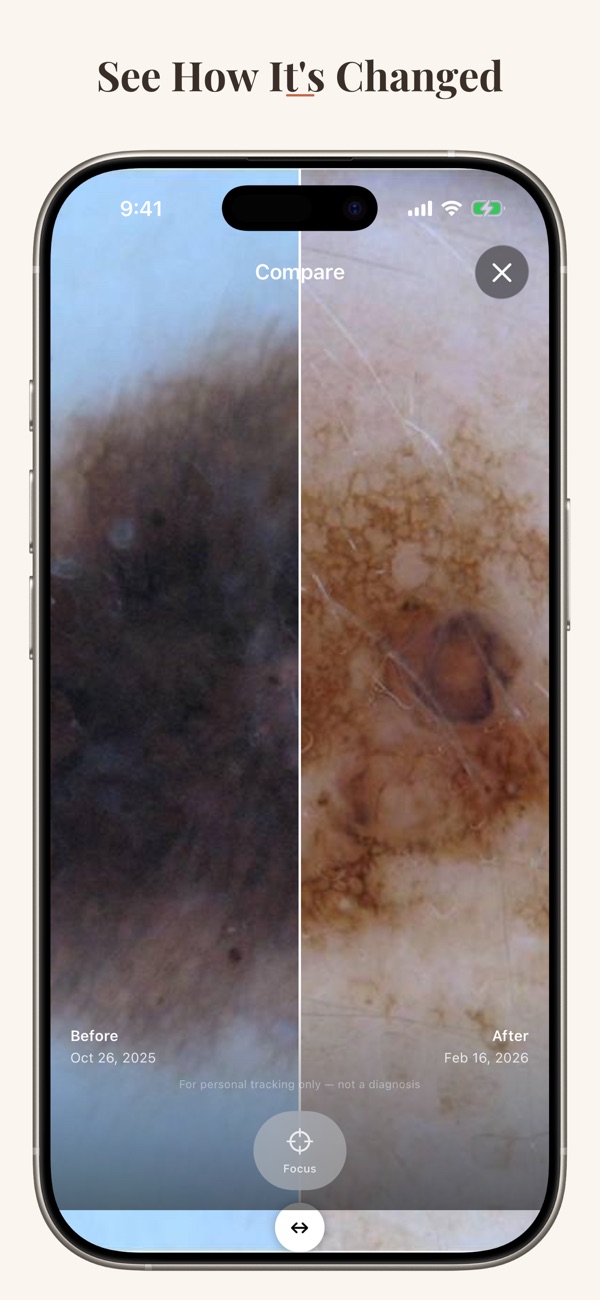 Skin Map comparing earlier and later mole photos